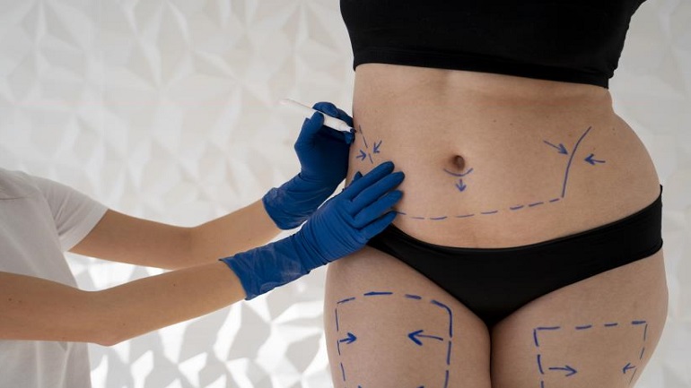 Liposuction ile Vücudünuzu Yeniden Şekillendirme Sanatı